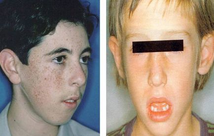 Аденоиден лицето детски снимки, как да се фиксират аденоиден тип човек