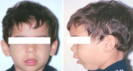 Аденоиден лицето детски снимки, как да се фиксират аденоиден тип човек