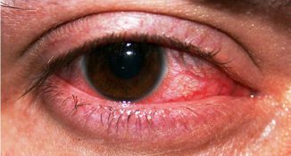Алергия сърбеж в очите и сълзене, подуване - отколкото да се лекува оток на клепачите на деца и възрастни