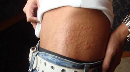 Алергични кожни симптоми, лечение, снимки