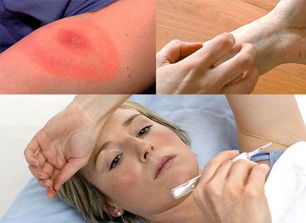 Алергия към пиявици симптоми снимка