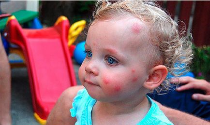 Алергия към ухапване от комари при децата снимка, симптоми, лечение