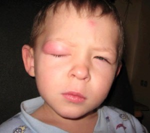 Алергия към ухапване от комари при децата снимка, симптоми, лечение