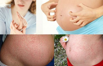 Алергии по време на бременност, отколкото лечение, таблет, ефекти върху плода