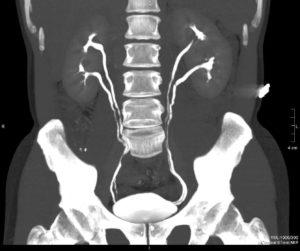 бъбречна angiomyolipoma - какво е това, причината и симптомите на болестта е