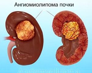 бъбречна angiomyolipoma - какво е това, причината и симптомите на болестта е