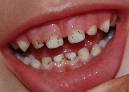 Черно патина на бебешки зъби и възрастни причините за, как да се премахне