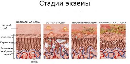 Екзема на краката причинява симптомите, снимки, методи на лечение и народни средства