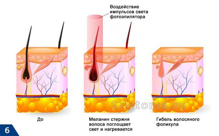 Фотоепилация - ревюта, противопоказания и ефекти цени