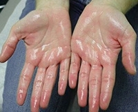 Изпотяване на дланите и стъпалата на какво е, причини, симптоми, лечение за изпотяване на ръцете и краката