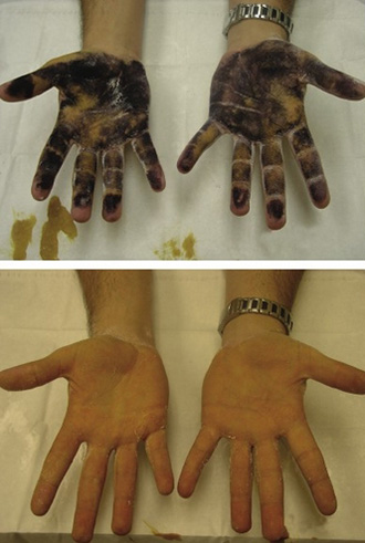 Изпотяване на дланите и стъпалата на какво е, причини, симптоми, лечение за изпотяване на ръцете и краката