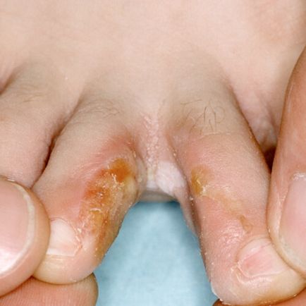 Гъбички между пръстите на краката лечение у дома