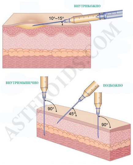 Стероиди инжекции, как да се направи инжекции, където пронизващи стероиди, стероиди като пронизваща