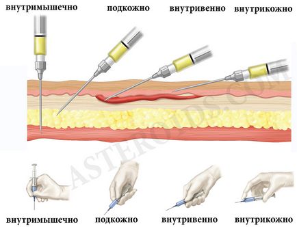 Стероиди инжекции, как да се направи инжекции, където пронизващи стероиди, стероиди като пронизваща