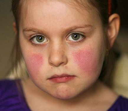 Инфекциозна еритем при деца - 30 снимки, симптоми и лечение, медицински сайт