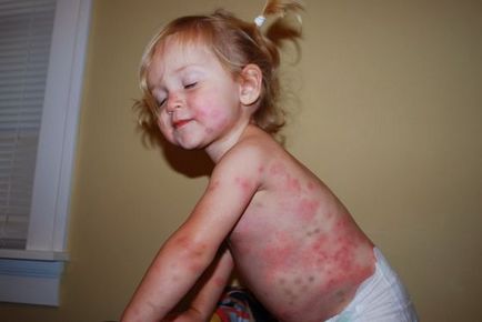 Инфекциозна еритем при деца - 30 снимки, симптоми и лечение, медицински сайт