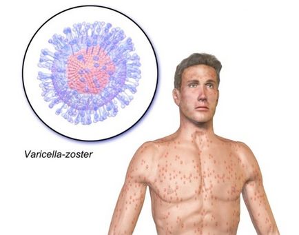 Как е варицела при деца и възрастни начини за предаване и инфекция период