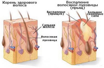 Как да премахнете пъпки от лицето й - марки, петна, у дома, на вечер, белези, белези