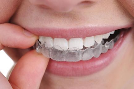 Как да се оправям зъбите у дома у дома изправяне на зъбите и чести грешки