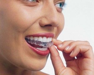 Как да се съгласуват зъбите без скоби у дома