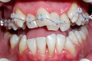 Как да се съгласуват зъбите у дома сам