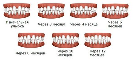 снимка Капа да приведе зъби, цена, ревюта