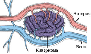 мозъка cavernoma (пещера ангиом и хемангиоми) какво е, последствията от лечението