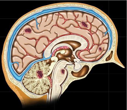 мозъка cavernoma причини, симптоми, диагностика, лечение, ефекти