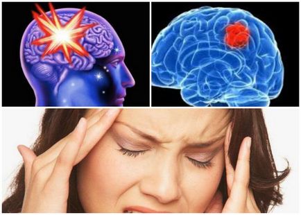 мозъка cavernoma причини, симптоми, диагностика, лечение, ефекти