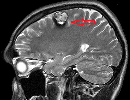 мозъка cavernoma симптоми, последствия