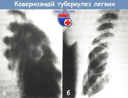 Кавернозен белодробна туберкулоза - клинична картина, диагноза