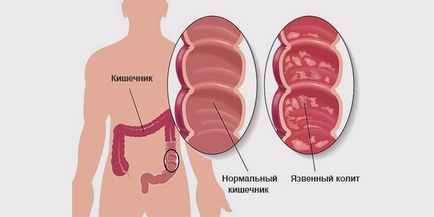 Колит, чревни симптоми и лечение на възрастни с народни средства