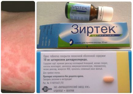 Червени петна по тялото на снимката, причините и е възможно заболяването, израстъци по кожата (червен) Червени петна по тялото на снимката, на причините и е възможно заболяването, образувания по кожата