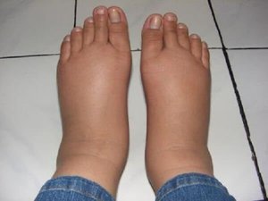 Лечение на болки в краката, а на дъното в близост до подножието на защо болезнено да ходи, причините и лечението