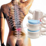 гръбначния херния лазерно лечение