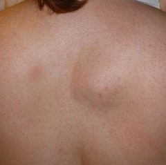 Липом на гърба й - отстраняване, симптоми, причини