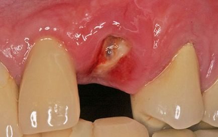 Зъб имплант симптоми на отхвърляне и причини