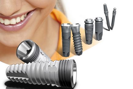 Зъб имплант симптоми на отхвърляне и причини