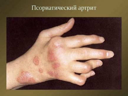 Артрит ставите на пръстите на лечение, причини и симптоми