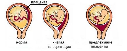 Плацента превия причини, симптоми, усложнения