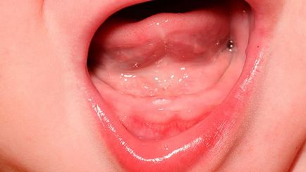 Изригване на горните зъби в детските снимки, симптоми