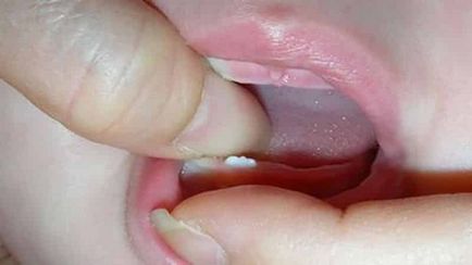 Никнене на млечни зъби симптоми на горните зъби при деца, снимки на венците, как да помагат на бебетата