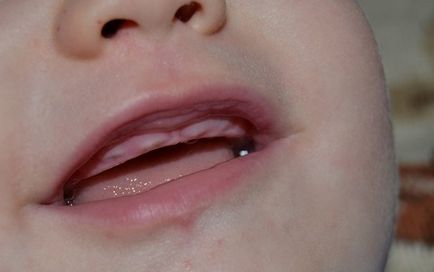 Никнене на млечни зъби симптоми на горните зъби при деца, снимки на венците, как да помагат на бебетата