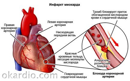 Инфарктът причинява симптомите, лечение и какво да правя
