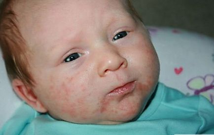 Стафилококус ауреус по лицето и кожата причини, симптоми и лечение