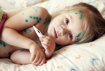 Варицела при деца - първите признаци, симптоми и лечение