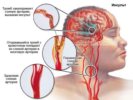 Всички симптоми на инсулт и първите признаци на пълен преглед