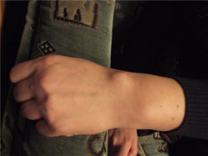 Вън по ръката причини, симптоми и лечение (причини) Вън по ръката причини, симптоми и лечение