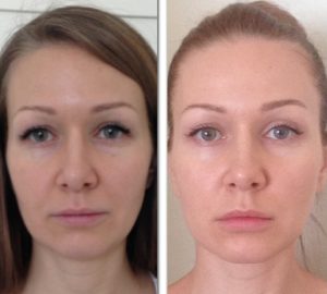 Фейслифт за лицевите упражнения, резултат от процедурата
