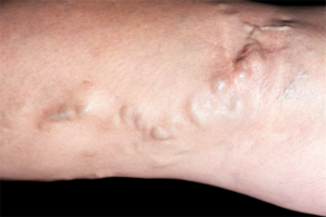 noduri varicoase pe picioare varicoza simptome de baza